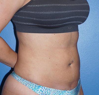 Liposuction Before & After Gallery - Patient 5227136 - Image 4