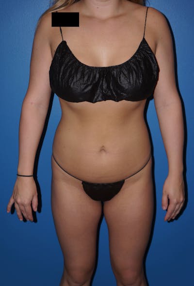 Liposuction Before & After Gallery - Patient 5227157 - Image 1