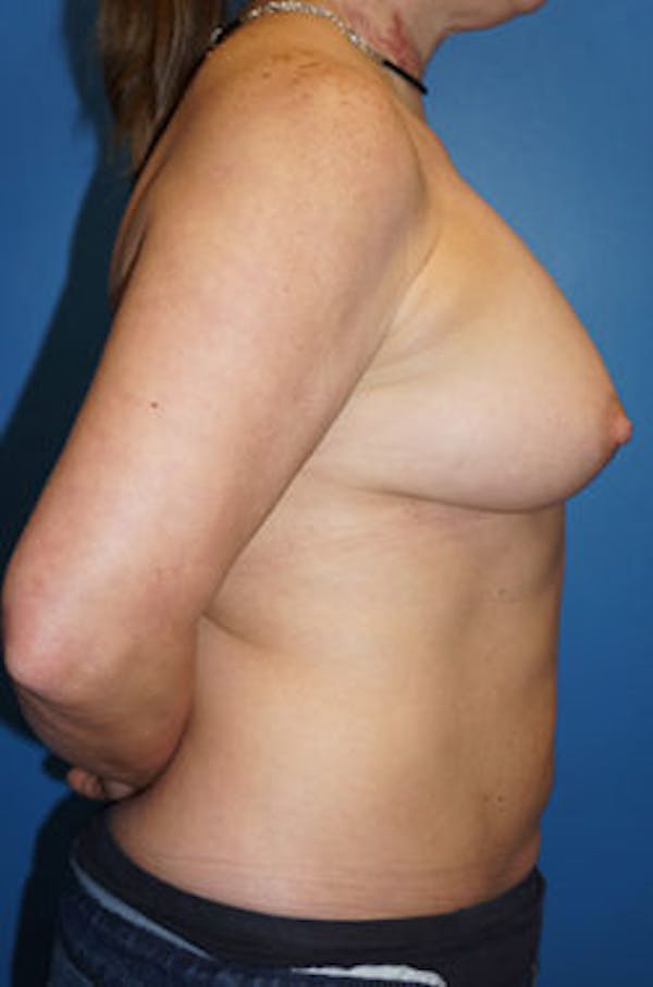 Breast Augmentation Gallery - Patient 5227282 - Image 2
