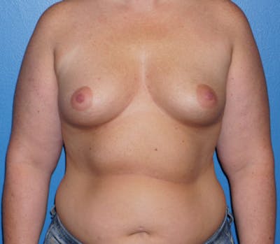 Breast Augmentation Before & After Gallery - Patient 5227283 - Image 1