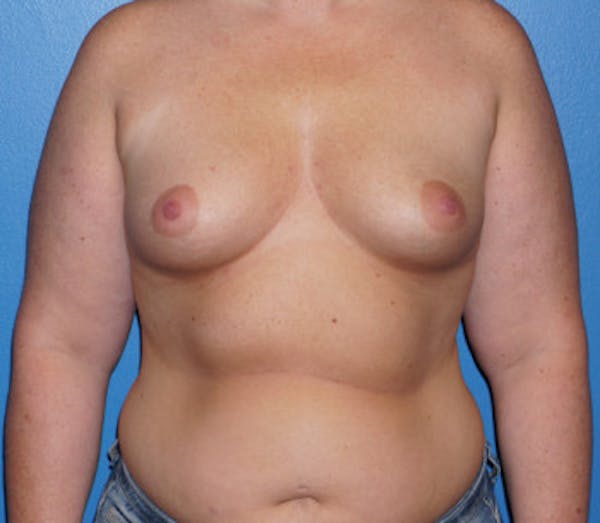 Breast Augmentation Before & After Gallery - Patient 5227283 - Image 1