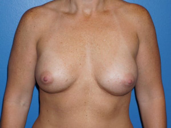 Breast Augmentation Gallery - Patient 5227284 - Image 2