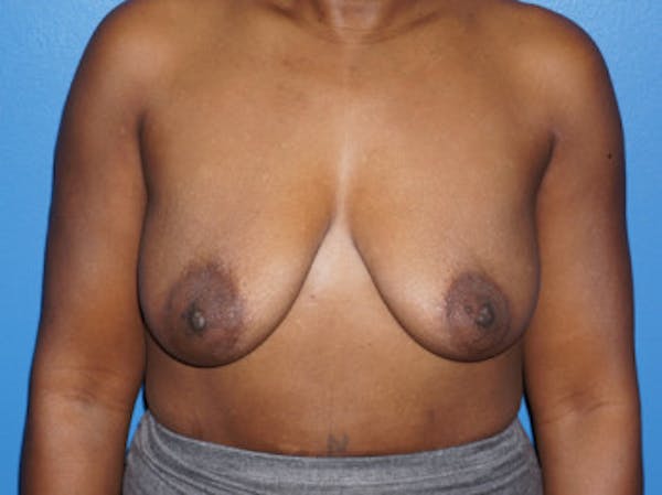 Breast Augmentation Before & After Gallery - Patient 5227288 - Image 1