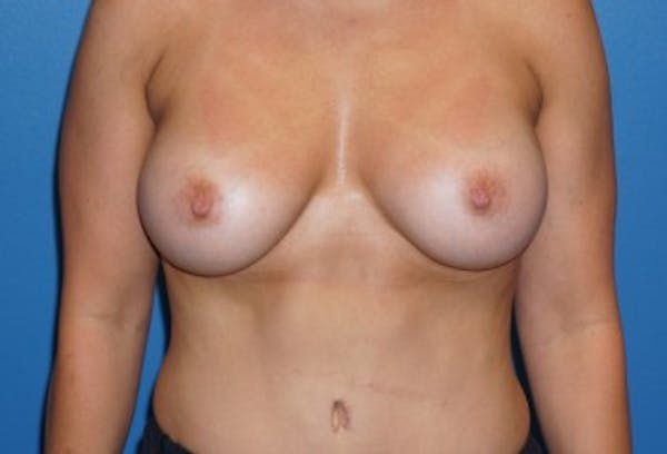 Breast Augmentation Gallery - Patient 5227291 - Image 2