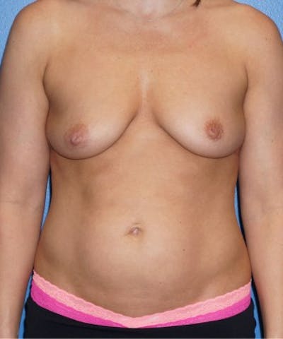Mommy Makeover Gallery - Patient 5227356 - Image 1