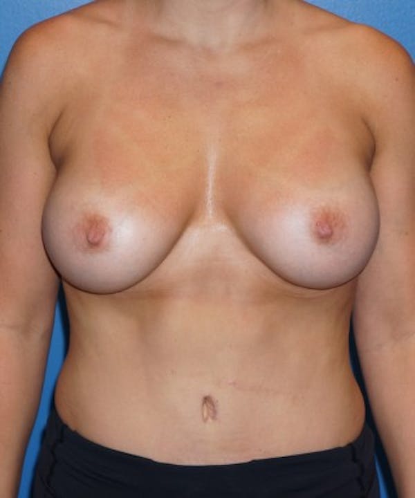 Mommy Makeover results in Houston with Dr. Lind