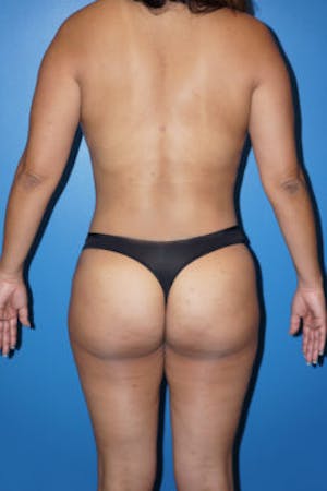 Before and after photos: post Liposuction and Brazilian butt lift with Dr. Lind