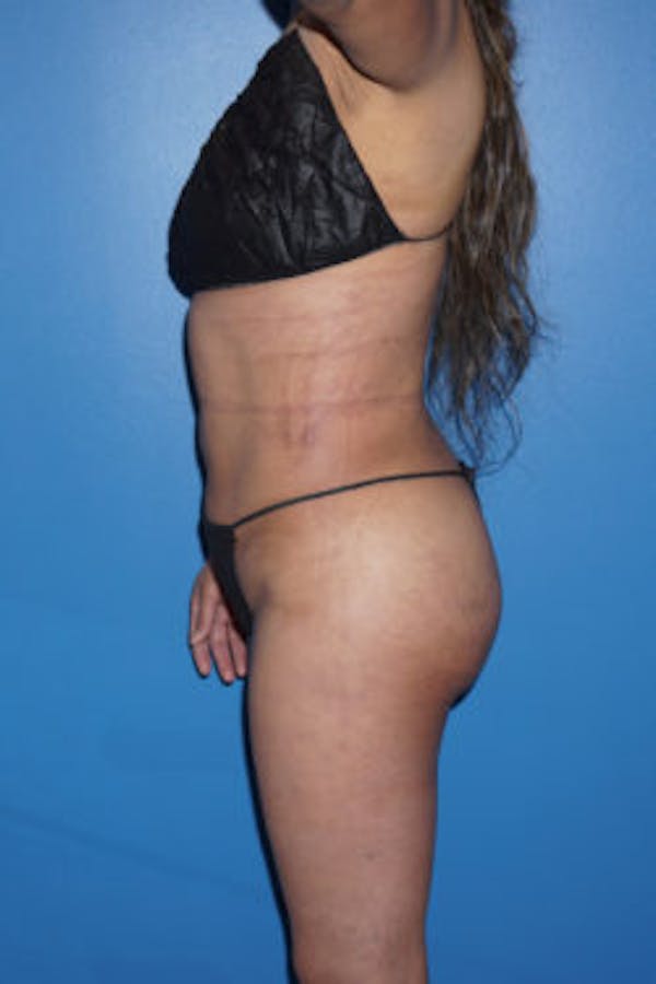 Liposuction Before & After Gallery - Patient 5227146 - Image 4