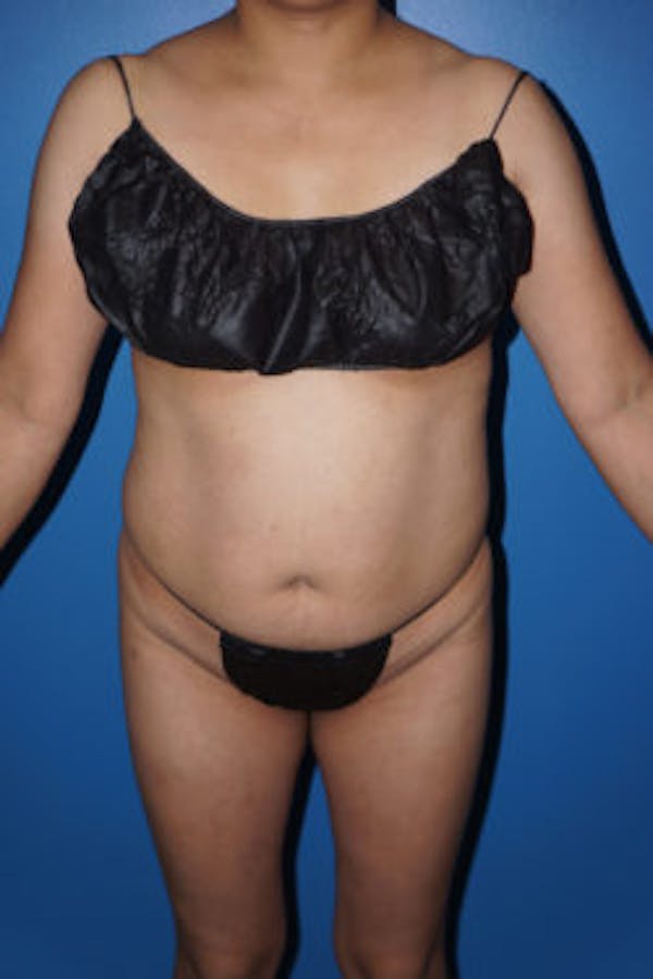 Liposuction Before & After Gallery - Patient 5227146 - Image 5