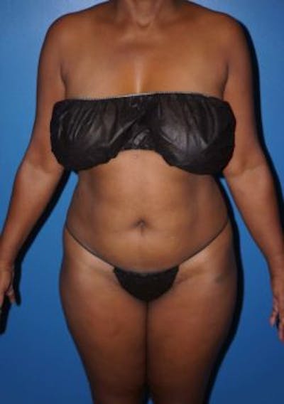 Liposuction Gallery - Patient 5227153 - Image 1