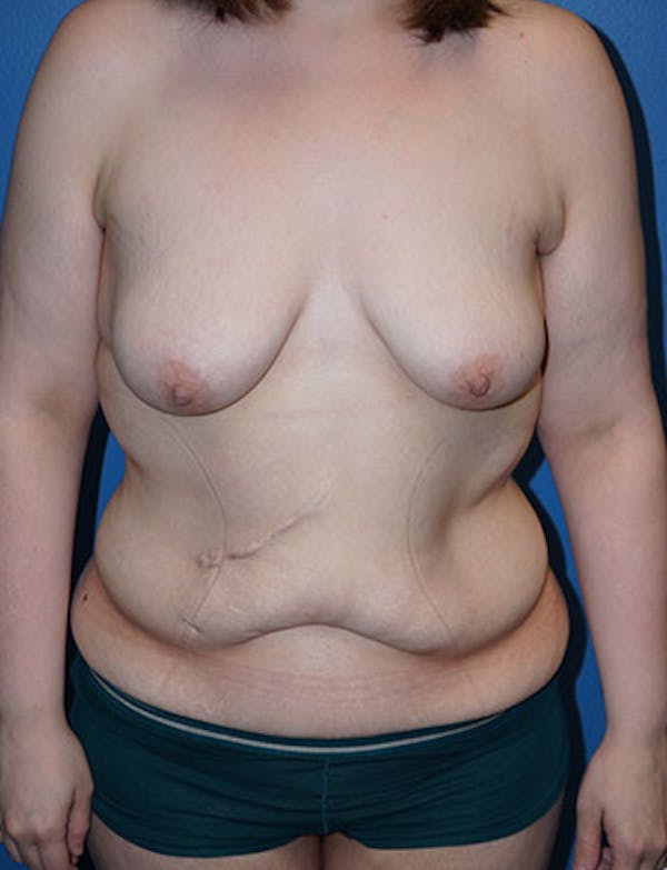 Dr. Lind patient before and after photo following Tummy Tuck with Breast Lift