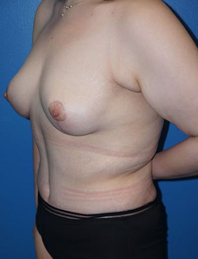 Tummy Tuck Before & After Gallery - Patient 5227189 - Image 4