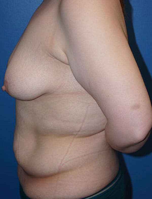 Tummy Tuck Before & After Gallery - Patient 5227189 - Image 5