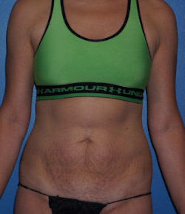 Abdominoplasty Results in Houston