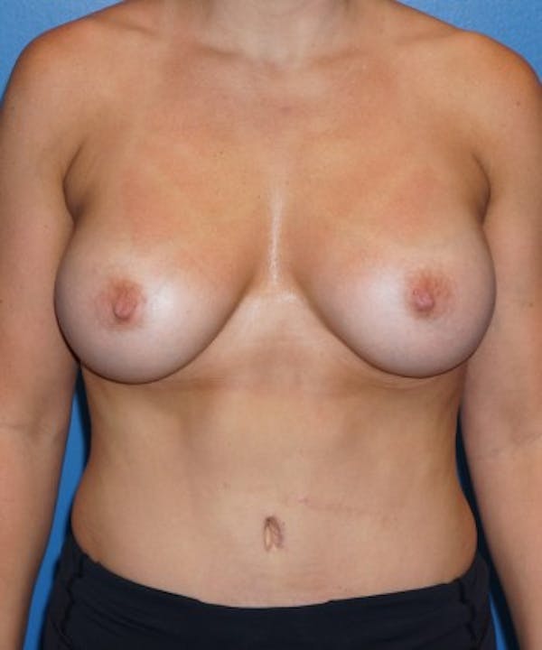 Tummy Tuck Before & After Gallery - Patient 5227620 - Image 2