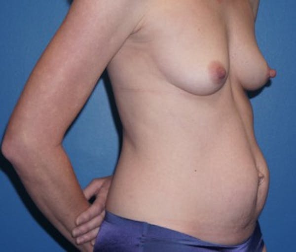 Tummy Tuck Before & After Gallery - Patient 5227621 - Image 1