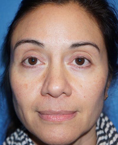 Halo Laser Before & After Gallery - Patient 5227627 - Image 2