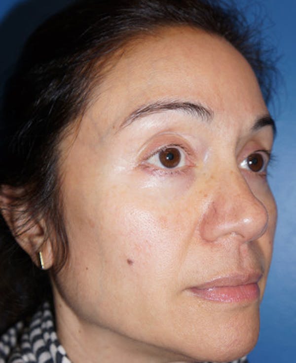 Halo Laser Before & After Gallery - Patient 5227627 - Image 4
