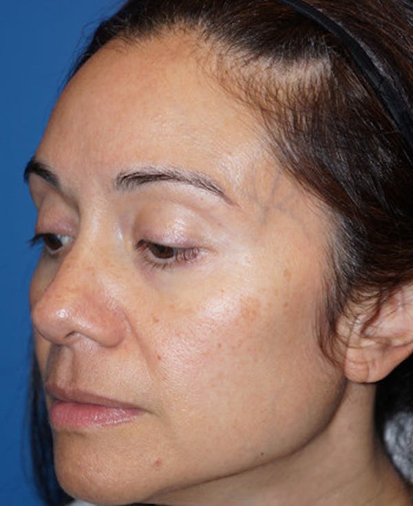 Halo Laser Before & After Gallery - Patient 5227627 - Image 5