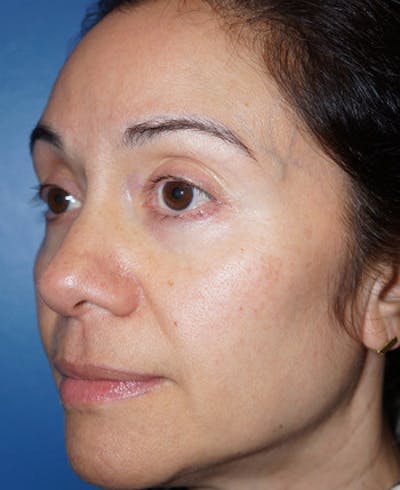 Halo Laser Before & After Gallery - Patient 5227627 - Image 6