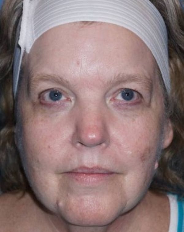 Halo Laser Before & After Gallery - Patient 5227628 - Image 1