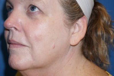 Halo Laser Before & After Gallery - Patient 5227628 - Image 6