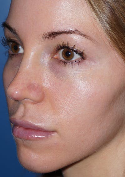 Cheek Filler Before & After Gallery - Patient 5227730 - Image 4