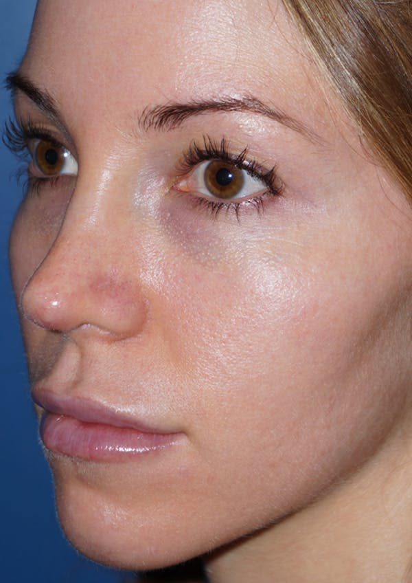 Cheek Filler Before & After Gallery - Patient 5227730 - Image 4