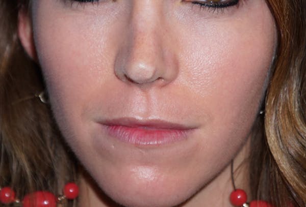 Non-Surgical Nose Job Gallery - Patient 5227735 - Image 1