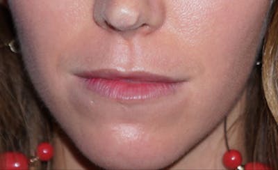Lip Filler Before & After Gallery - Patient 5227739 - Image 1