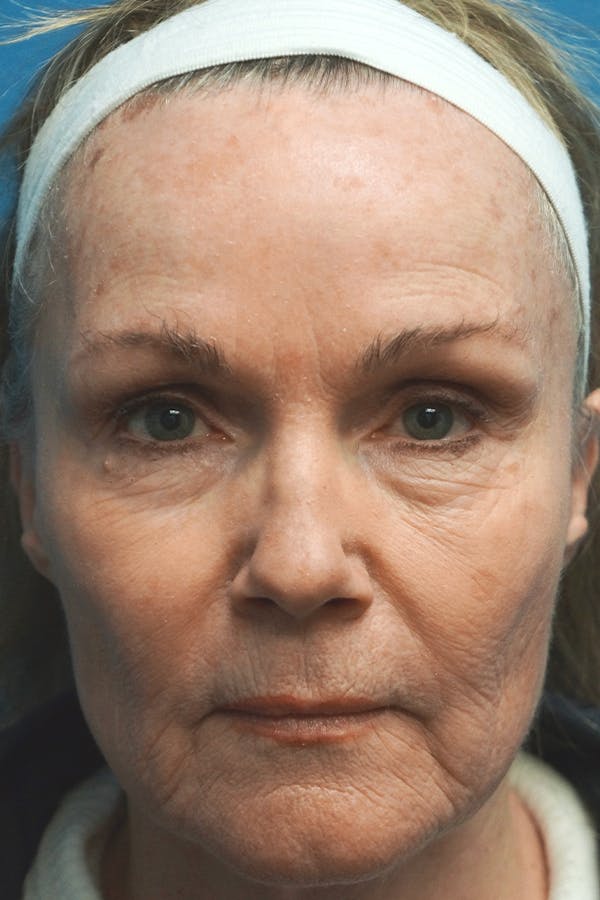 Contour TRL Before & After Gallery - Patient 7627519 - Image 1