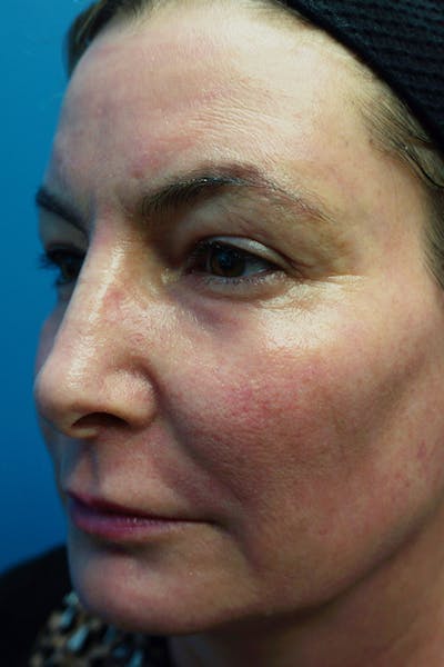 Contour TRL Before & After Gallery - Patient 7627520 - Image 1