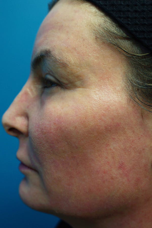 Contour TRL Before & After Gallery - Patient 7627520 - Image 3