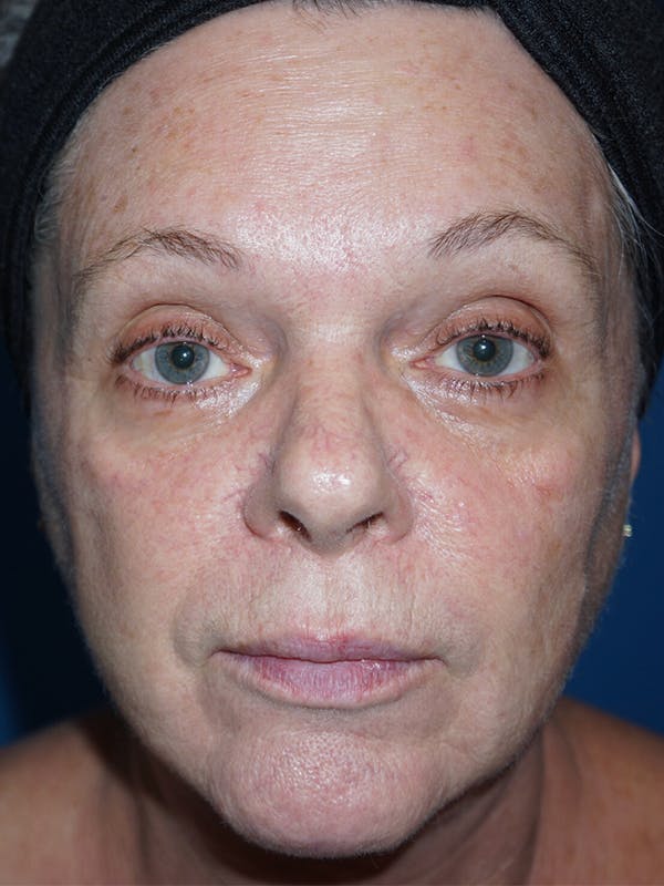 Halo Laser Before & After Gallery - Patient 7627530 - Image 1