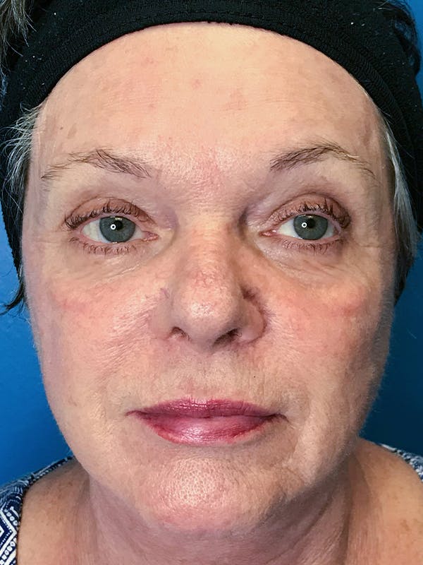 Halo Laser Before & After Gallery - Patient 7627530 - Image 2