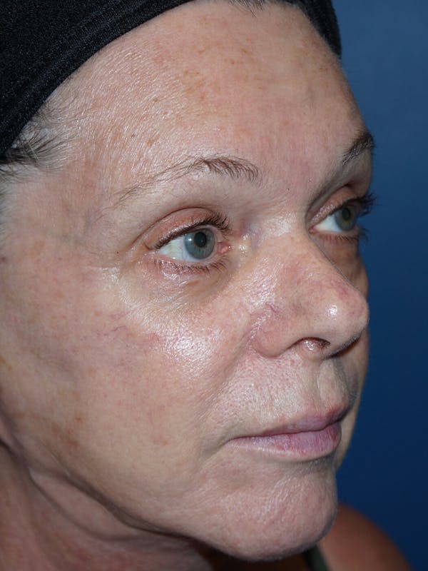 Halo Laser Before & After Gallery - Patient 7627530 - Image 3