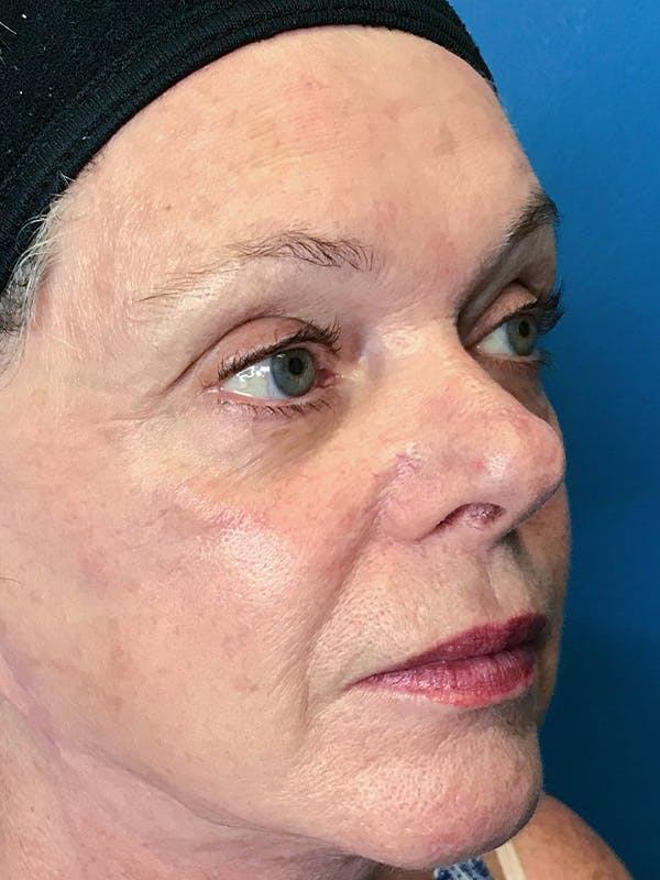 Halo Laser Before & After Gallery - Patient 7627530 - Image 4