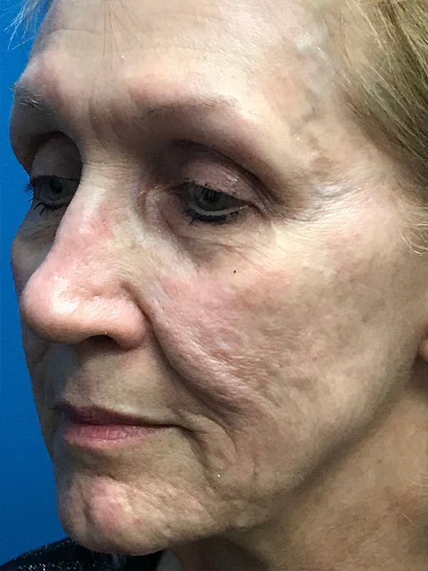 Halo Laser Before & After Gallery - Patient 7627532 - Image 3