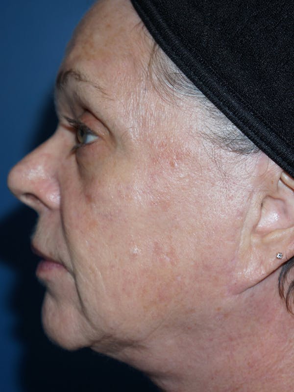 Halo Laser Before & After Gallery - Patient 7627530 - Image 5