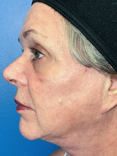 Halo Laser Before & After Gallery - Patient 7627530 - Image 6