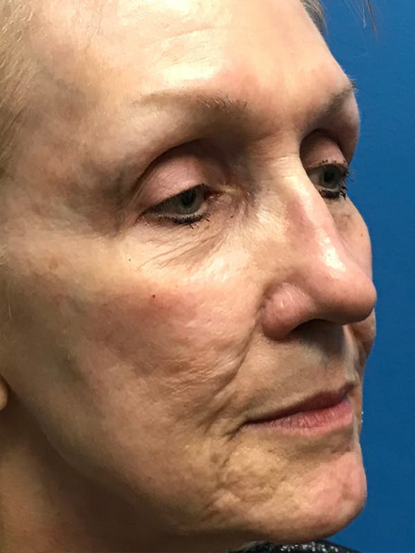 Halo Laser Before & After Gallery - Patient 7627532 - Image 5