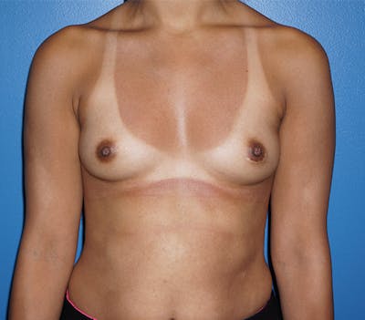 Breast Augmentation Before & After Gallery - Patient 11186807 - Image 1