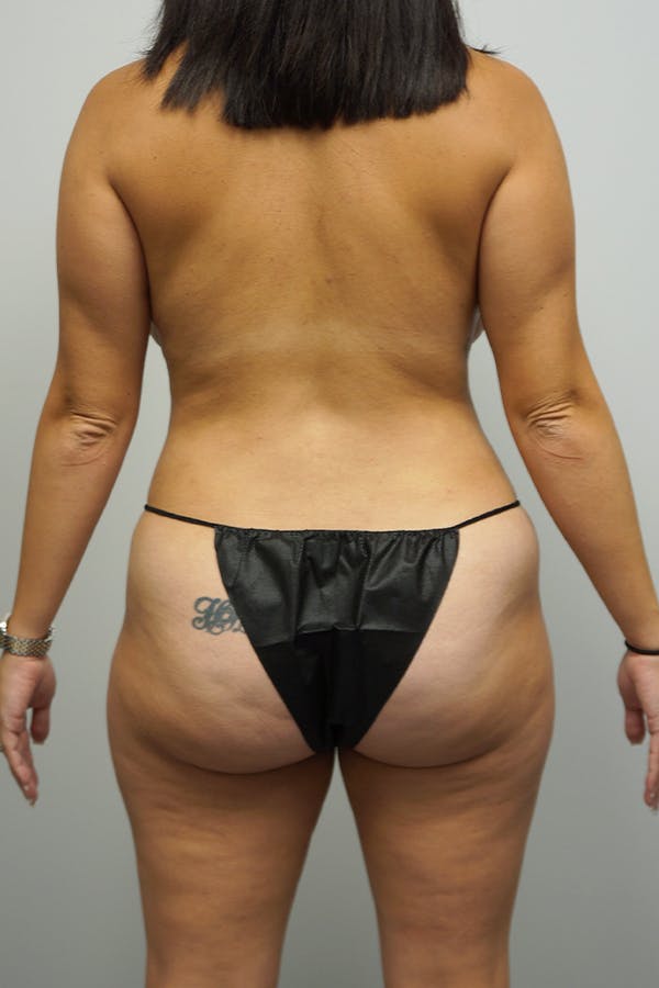Liposuction Before & After Gallery - Patient 11186979 - Image 2