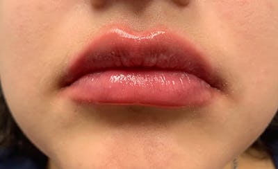 Lip Filler Before & After Gallery - Patient 11676300 - Image 2