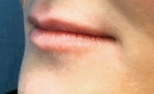 Lip Filler Before & After Gallery - Patient 11676301 - Image 1