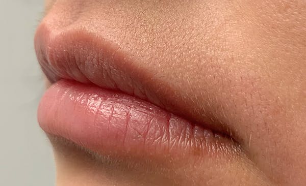 Lip Filler Before & After Gallery - Patient 11676300 - Image 3