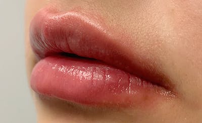 Lip Filler Before & After Gallery - Patient 11676300 - Image 4