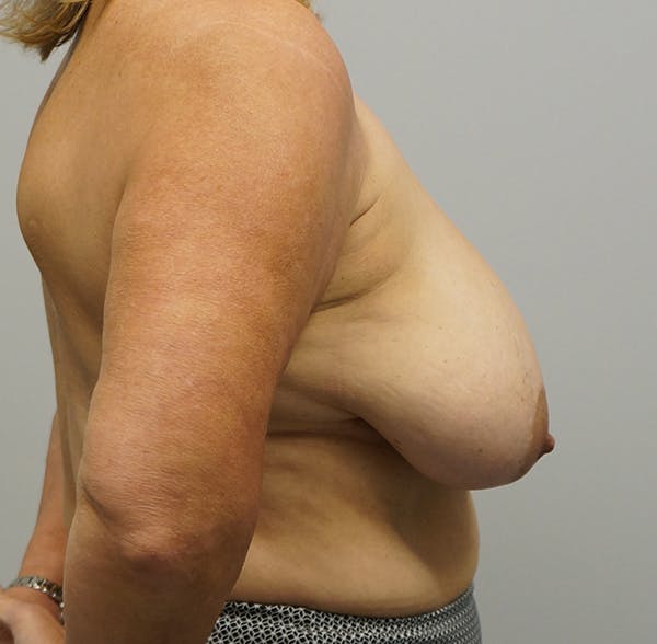 Breast Reduction Before & After Gallery - Patient 55260832 - Image 1