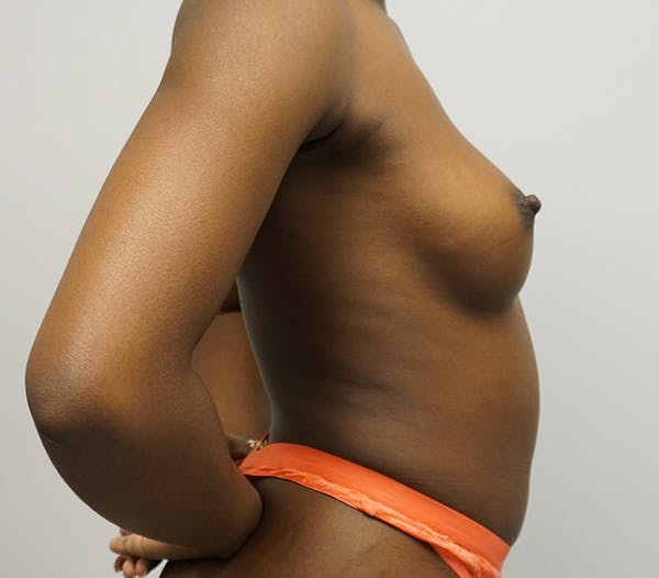 Breast Augmentation Gallery - Patient 55260856 - Image 1