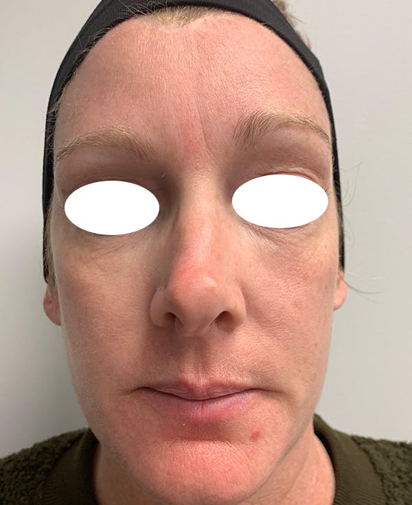 Halo Laser Before & After Gallery - Patient 55260909 - Image 2
